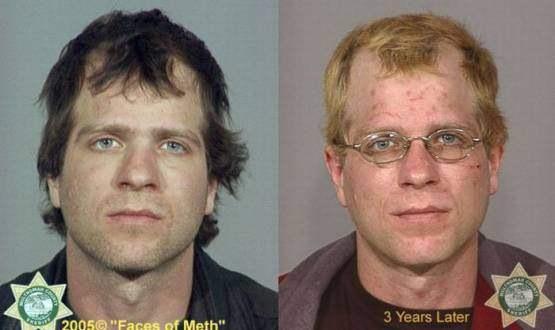 Faces-of-Meth-Before-and-After-Death_25