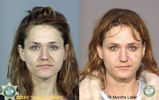 Faces-of-Meth-Before-and-After-Death_39