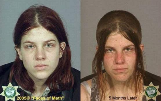 Faces-of-Meth-Before-and-After-Death_5